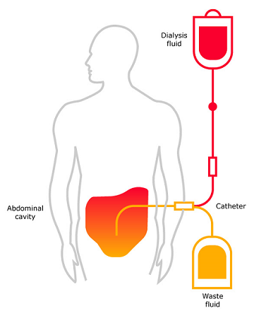 Principle of Continuous Ambulatory Peritoneal Dialysis (CAPD)