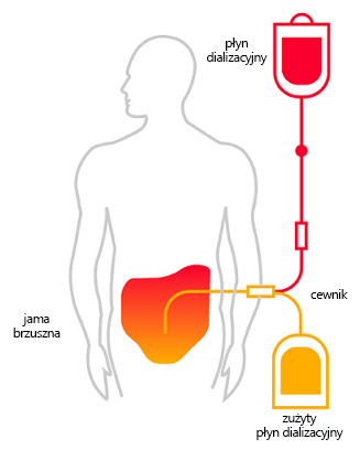 Peritoneal dialysis _image