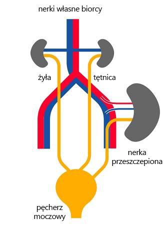 kidney_transplantation