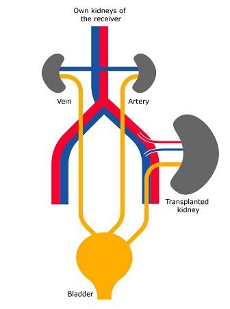 Location of the transplanted kidney
